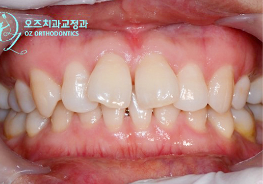 교정 전 앞니